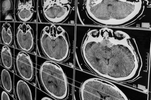 Brain CT scan images displayed on a medical monitor, representing traumatic brain injury diagnosis after an accident.